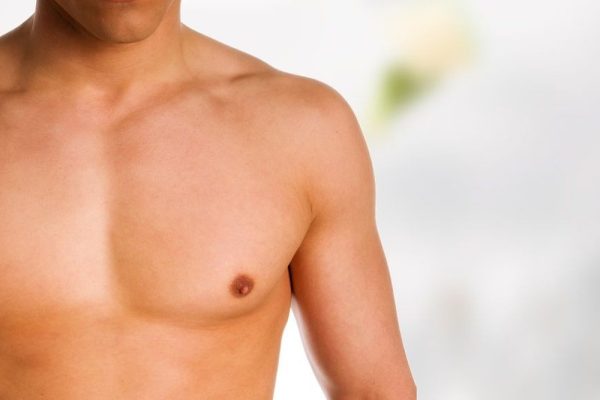Gynecomastia