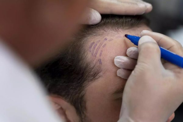 Sapphire FUE Hair Transplant Turkey