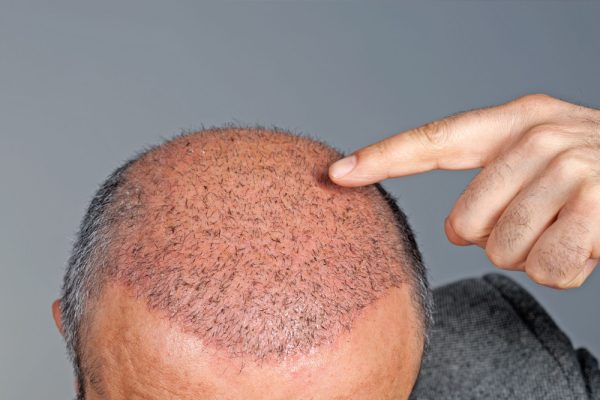 Greffe de Cheveux Turquie