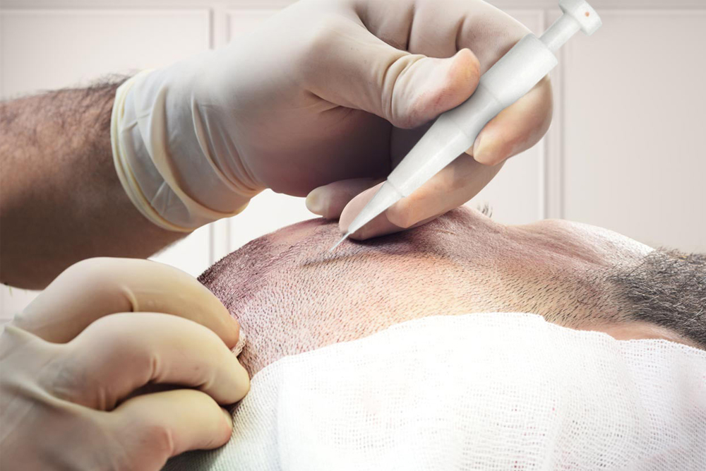 DHI Hair Transplant Turquie