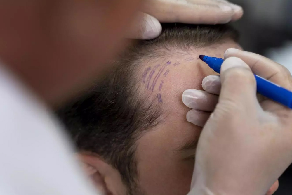 Sapphire FUE Hair Transplant Turquie